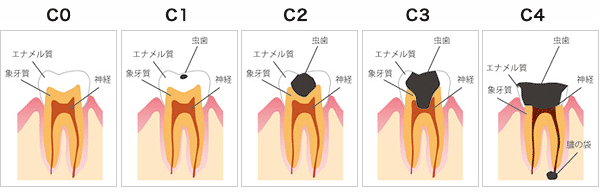 虫歯