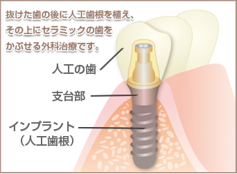 ホワイトニング